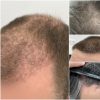 Pigios plaukų transplantacijos Turkijoje vėliau atsieina daug brangiau: patiria rimtų pažeidimų