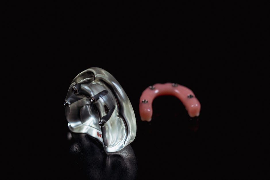 Skaitmeninė implantacija – dantų implantacijos metodas, užtikrinantis sėkmę ir ilgaamžiškumą
