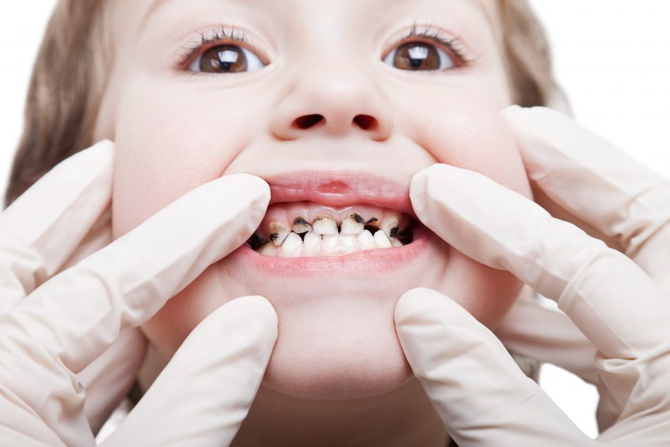 Skylėti vaikų dantys – tėvų sąžinės reikalas