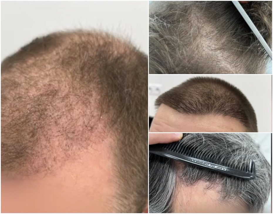 Pigios plaukų transplantacijos Turkijoje vėliau atsieina daug brangiau: patiria rimtų pažeidimų