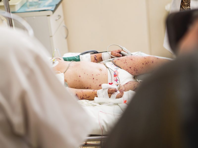 Kauno apskrityje – du meningokokinės infekcijos atvejai: susirgo mažamečiai 
